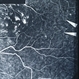 neonatal herpesvirus infection showing microvascular occlusion, capillary dilatation, and paramacular leakage.